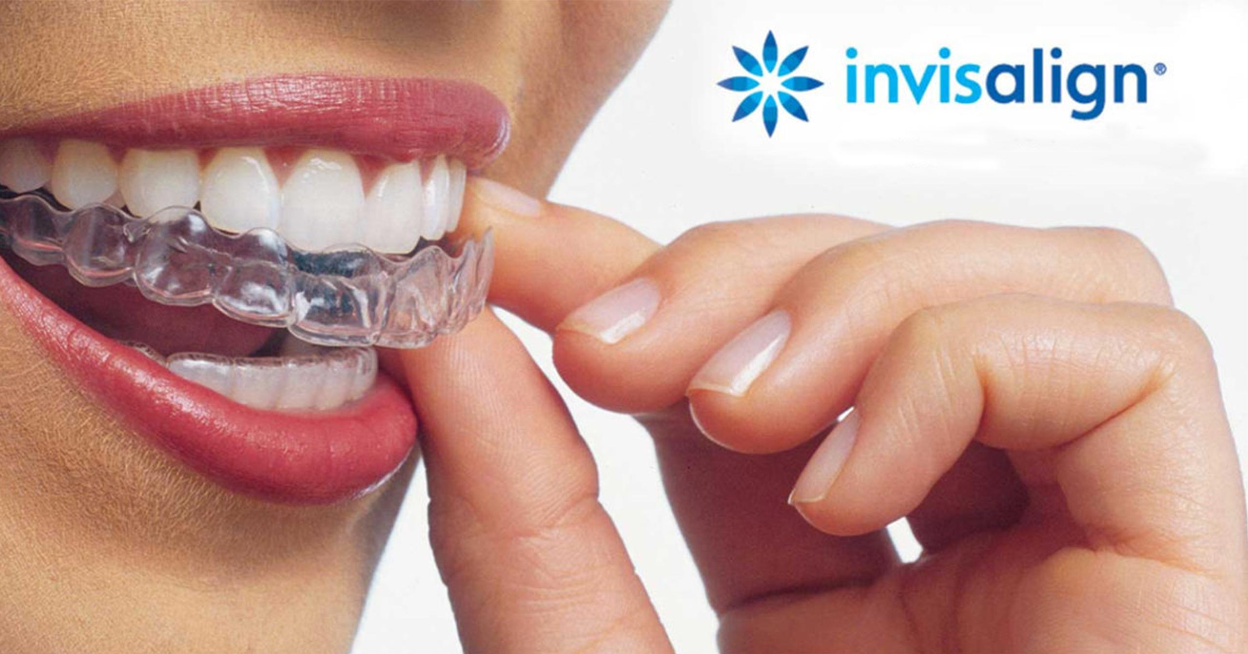 cabinet-orthodontie-villemagne-avignon-gouttieres-invisalign